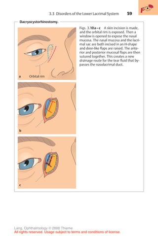 59
Dacryocystorhinostomy.
Orbital rim
a
b
c
Figs. 3.10a–c A skin incision is made,
and the orbital rim is exposed. Then a
window is opened to expose the nasal
mucosa. The nasal mucosa and the lacri-
mal sac are both incised in an H-shape
and door-like flaps are raised. The ante-
rior and posterior mucosal flaps are then
sutured together. This creates a new
drainage route for the tear fluid that by-
passes the nasolacrimal duct.
3.3 Disorders of the Lower Lacrimal System
Lang, Ophthalmology © 2000 Thieme
All rights reserved. Usage subject to terms and conditions of license.
 