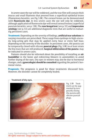 63
In severe cases the eye will be reddened, and the tear film will contain thick
mucus and small filaments that proceed from a superficial epithelial lesion
(filamentary keratitis; see Fig. 5.11). The corneal lesion can be demonstrated
with fluorescein dye. In less severe cases the eye will only be reddened,
although application of fluorescein dye will reveal corneal lesions (superficial
punctate keratitis; see p. 138). The rose bengal test (see p. 52) and impression
cytology (see p. 53) are additional diagnostic tests that are useful in evaluat-
ing persistent cases.
Treatment: Depending on the severity of findings, artificial tear solutions in
varying viscosities are prescribed. These range from eyedrops to high-viscos-
ity long-acting gels that may be applied every hour or every half hour,
depending on the severity of the disorder. In persistent cases, the puncta can
be temporarily closed with silicone punctal plugs (Fig. 3.11) to at least retain
the few tears that are still produced. Surgical obliteration of the puncta may
be indicated in severe cases.
Patients should also be informed about the possibility of installing an air
humidifier in the home and redirecting blowers in automobiles to avoid
further drying of the eyes. Dry eyes in women may also be due to hormonal
changes, and a gynecologist should be consulted regarding the patient’s hor-
monal status.
Prognosis: The prognosis is good for those treatments discussed here.
However, the disorder cannot be completely healed.
Treatment of dry eyes.
Fig. 3.11 Treat-
ment can be aug-
mented by tem-
porarily closing
the puncta with
silicone punctal
plugs.
3.4 Lacrimal System Dysfunction
Lang, Ophthalmology © 2000 Thieme
All rights reserved. Usage subject to terms and conditions of license.
 