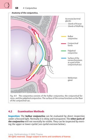68
Anatomy of the conjunctiva.
Glands of Krause
Glands of Wolfring
Accessory lacrimal
glands:
Meibomian
gland
Bulbar
conjunctiva
Conjunctival
fornix
Palpebral
conjunctiva
Surface of the
cornea (functions
as a part of the
conjunctival sac)
Fig. 4.1 The conjunctiva consists of the bulbar conjunctiva, the conjunctival for-
nices, and the palpebral conjunctiva. The surface of the cornea functions as the floor
of the conjunctival sac.
4.2 Examination Methods
Inspection: The bulbar conjunctiva can be evaluated by direct inspection
under a focused light. Normally it is shiny and transparent. The other parts of
the conjunctiva will not normally be visible. They can be inspected by evert-
ing the upper or lower eyelid (see eyelid eversion below).
4 Conjunctiva
Lang, Ophthalmology © 2000 Thieme
All rights reserved. Usage subject to terms and conditions of license.
 
