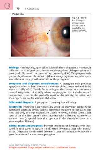 70
Pinguecula.
Fig. 4.2 Harm-
less triangular
pingueculum
whose base is
parallel to the
cornea (arrow).
Etiology: Histologically, a pterygium is identical to a pinguecula. However, it
differs in that it can grow on to the cornea; the gray head of the pterygium will
grow gradually toward the center of the cornea (Fig. 4.3a). This progression is
presumably the result of a disorder of Bowman’s layer of the cornea, which pro-
vides the necessary growth substrate for the pterygium.
Symptoms and diagnostic considerations: A pterygium only produces
symptoms when its head threatens the center of the cornea and with it the
visual axis (Fig. 4.3b). Tensile forces acting on the cornea can cause severe
corneal astigmatism. A steadily advancing pterygium that includes scarred
conjunctival tissue can also gradually impair ocular motility; the patient will
then experience double vision in abduction.
Differential diagnosis: A pterygium is an unequivocal finding.
Treatment: Treatment is only necessary when the pterygium produces the
symptoms discussed above. Surgical removal is indicated in such cases. The
head and body of the pterygium are largely removed, and the sclera is left
open at the site. The cornea is then smoothed with a diamond reamer or an
excimer laser (a special laser that operates in the ultraviolet range at a
wavelength of 193 nm).
Clinical course and prognosis: Pterygia tend to recur. Keratoplasty is indi-
cated in such cases to replace the diseased Bowman’s layer with normal
tissue. Otherwise the diseased Bowman’s layer will continue to provide a
growth substrate for a recurrent pterygium.
4 Conjunctiva
Lang, Ophthalmology © 2000 Thieme
All rights reserved. Usage subject to terms and conditions of license.
 