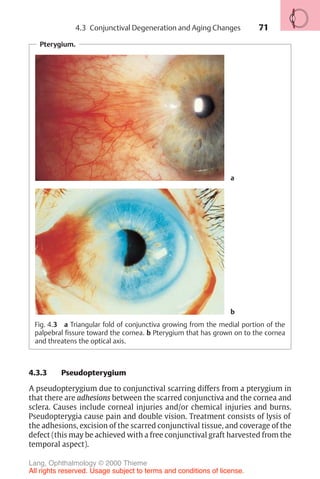 71
Pterygium.
Fig. 4.3 a Triangular fold of conjunctiva growing from the medial portion of the
palpebral fissure toward the cornea. b Pterygium that has grown on to the cornea
and threatens the optical axis.
a
b
4.3.3 Pseudopterygium
A pseudopterygium due to conjunctival scarring differs from a pterygium in
that there are adhesions between the scarred conjunctiva and the cornea and
sclera. Causes include corneal injuries and/or chemical injuries and burns.
Pseudopterygia cause pain and double vision. Treatment consists of lysis of
the adhesions, excision of the scarred conjunctival tissue, and coverage of the
defect (this may be achieved with a free conjunctival graft harvested from the
temporal aspect).
4.3 Conjunctival Degeneration and Aging Changes
Lang, Ophthalmology © 2000 Thieme
All rights reserved. Usage subject to terms and conditions of license.
 
