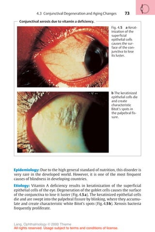 73
Epidemiology: Due to the high general standard of nutrition, this disorder is
very rare in the developed world. However, it is one of the most frequent
causes of blindness in developing countries.
Etiology: Vitamin A deficiency results in keratinization of the superficial
epithelial cells of the eye. Degeneration of the goblet cells causes the surface
of the conjunctiva to lose it luster (Fig. 4.5a). The keratinized epithelial cells
die and are swept into the palpebral fissure by blinking, where they accumu-
late and create characteristic white Bitot’s spots (Fig. 4.5b). Xerosis bacteria
frequently proliferate.
Conjunctival xerosis due to vitamin a deficiency.
Fig. 4.5 a Kerat-
inization of the
superficial
epithelial cells
causes the sur-
face of the con-
junctiva to lose
its luster.
b The keratinized
epithelial cells die
and create
characteristic
Bitot’s spots in
the palpebral fis-
sure.
4.3 Conjunctival Degeneration and Aging Changes
Lang, Ophthalmology © 2000 Thieme
All rights reserved. Usage subject to terms and conditions of license.
 