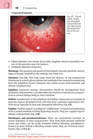 78
Conjunctival injection.
Fig. 4.7 Clearly
visible, bright
red, distended
conjunctival ves-
sels, decreasing
toward the lim-
bus of the cor-
nea.
❖ Ciliary injection (not clearly discernible, brightly colored nonmobile ves-
sels in the episclera near the limbus).
❖ Composite injection (frequent).
Discharge. The quantity and nature of the exudate (mucoid, purulent, watery,
ropy, or bloody) depend on the etiology (see Table 4.1).
Chemosis (Fig. 4.8). This may range from the absence of any conjunctival
thickening to a white glassy edema and swelling of the conjunctiva projecting
from the palpebral fissure (chemosis this severe occurs with bacterial and
allergic conjunctivitis).
Epiphora (excessive tearing). Illacrimation should be distinguished from
exudation. Illacrimation is usually reflex lacrimation in reaction to a conjunc-
tival or corneal foreign body or toxic irritation.
Follicle. Lymphocytes in the palpebral and bulbar conjunctiva accumulate in
punctate masses of lymph tissue cells that have a granular appearance. Fol-
licles occur typically in viral and chlamydial infections (Fig. 4.9).
Papillae. Papillae appear as polygonal “cobblestone” conjunctival projections
with a central network of finely branching vessels. They are a typical sign of
allergic conjunctivitis (Fig. 4.10).
Membranes and pseudomembranes. These are conjunctival reactions to
severe infectious or toxic conjunctivitis. They form from necrotic epithelial
tissue and either can be easily removed without bleeding (pseudomem-
branes) or leave behind a bleeding surface when they are removed (mem-
branes; Figs. 4.11a, b).
4 Conjunctiva
Lang, Ophthalmology © 2000 Thieme
All rights reserved. Usage subject to terms and conditions of license.
 