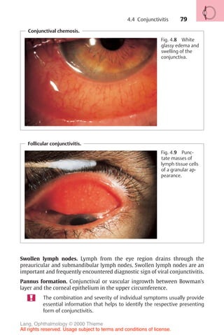 79
Conjunctival chemosis.
Fig. 4.8 White
glassy edema and
swelling of the
conjunctiva.
Follicular conjunctivitis.
Fig. 4.9 Punc-
tate masses of
lymph tissue cells
of a granular ap-
pearance.
Swollen lymph nodes. Lymph from the eye region drains through the
preauricular and submandibular lymph nodes. Swollen lymph nodes are an
important and frequently encountered diagnostic sign of viral conjunctivitis.
Pannus formation. Conjunctival or vascular ingrowth between Bowman’s
layer and the corneal epithelium in the upper circumference.
The combination and severity of individual symptoms usually provide
essential information that helps to identify the respective presenting
form of conjunctivitis.
4.4 Conjunctivitis
Lang, Ophthalmology © 2000 Thieme
All rights reserved. Usage subject to terms and conditions of license.
 