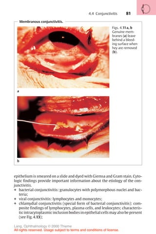 81
Membranous conjunctivitis.
Figs. 4.11a, b
Genuine mem-
branes (a) leave
behind a bleed-
ing surface when
hey are removed
(b).
epithelium is smeared on a slide and dyed with Giemsa and Gram stain. Cyto-
logic findings provide important information about the etiology of the con-
junctivitis.
❖ bacterial conjunctivitis: granulocytes with polymorphous nuclei and bac-
teria;
❖ viral conjunctivitis: lymphocytes and monocytes;
❖ chlamydial conjunctivitis (special form of bacterial conjunctivitis): com-
posite findings of lymphocytes, plasma cells, and leukocytes; characteris-
tic intracytoplasmic inclusion bodies in epithelial cells may also be present
(see Fig. 4.13);
a
b
4.4 Conjunctivitis
Lang, Ophthalmology © 2000 Thieme
All rights reserved. Usage subject to terms and conditions of license.
 