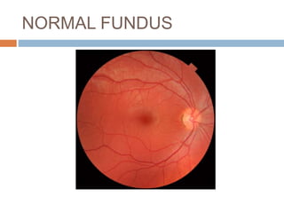 NORMAL FUNDUS
 