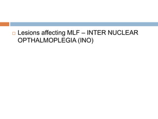  Lesions affecting MLF – INTER NUCLEAR
OPTHALMOPLEGIA (INO)
 