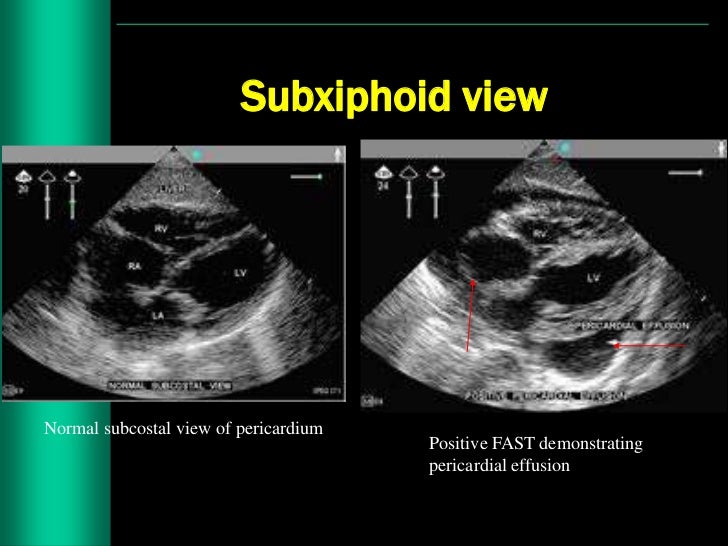 pericardial sac