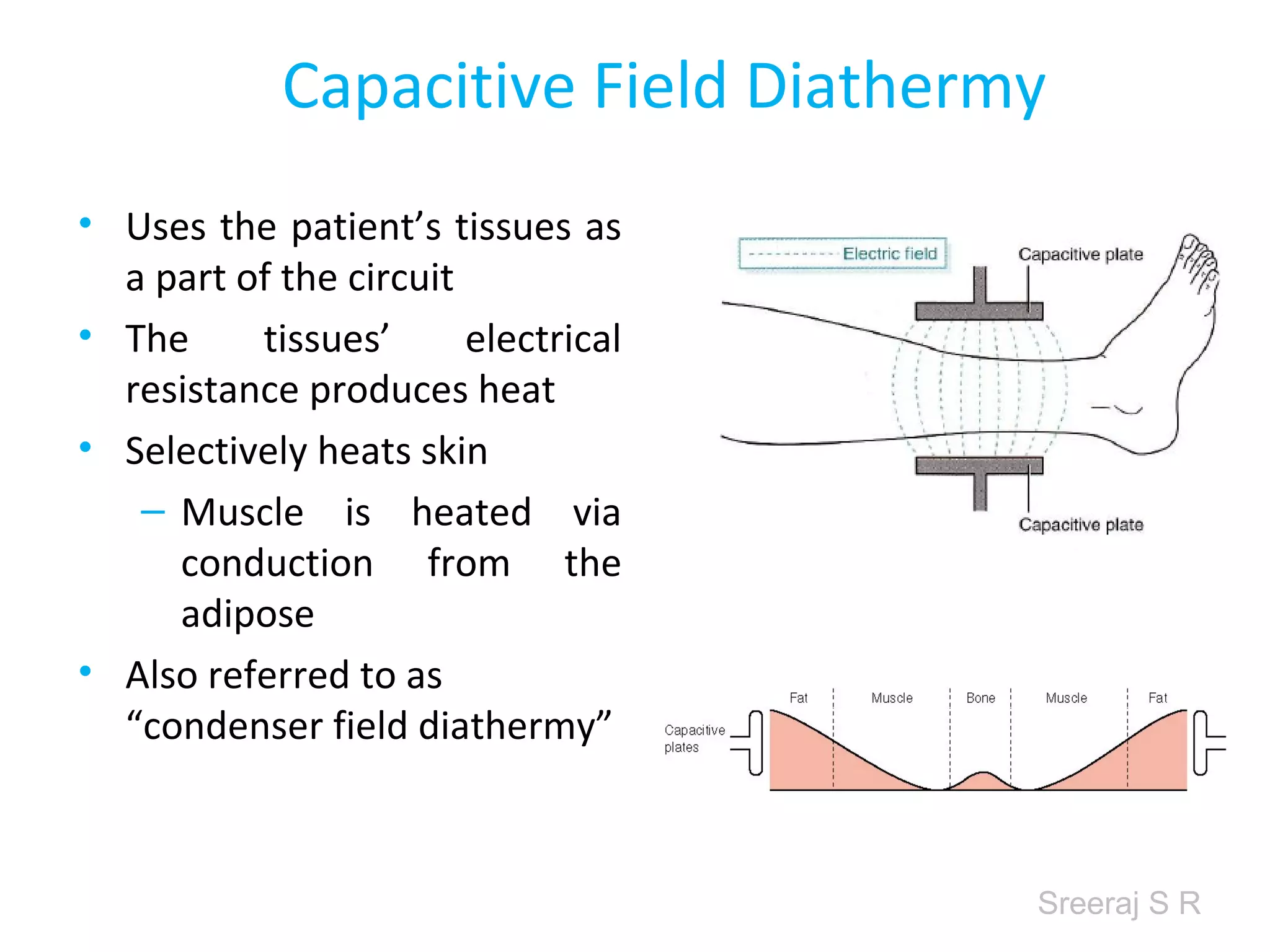Sreeraj S R
Capacitive Field Diathermy
• Uses the patient’s tissues as
a part of the circuit
• The tissues’ electrical
resistance produces heat
• Selectively heats skin
– Muscle is heated via
conduction from the
adipose
• Also referred to as
“condenser field diathermy”
 