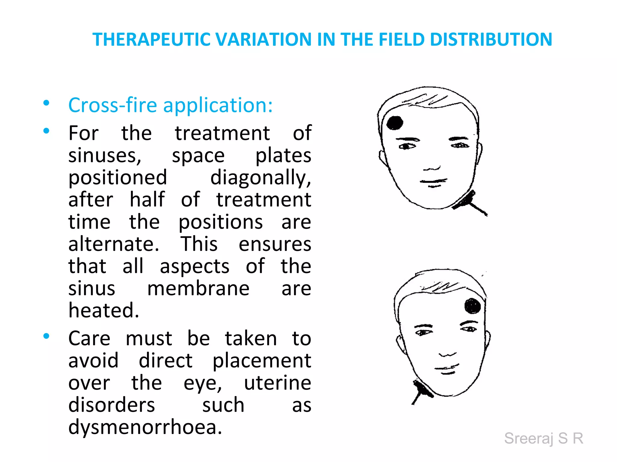 Sreeraj S R
THERAPEUTIC VARIATION IN THE FIELD DISTRIBUTION
• Cross-fire application:
• For the treatment of
sinuses, space plates
positioned diagonally,
after half of treatment
time the positions are
alternate. This ensures
that all aspects of the
sinus membrane are
heated.
• Care must be taken to
avoid direct placement
over the eye, uterine
disorders such as
dysmenorrhoea.
 
