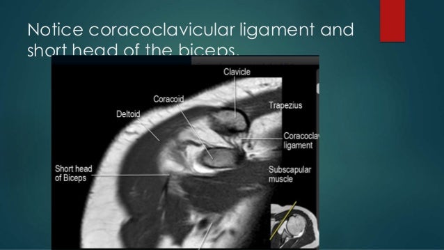 RADIOLOGICAL ANATOMY OF UPPER LIMB(SHOULDER@ELBOW)
