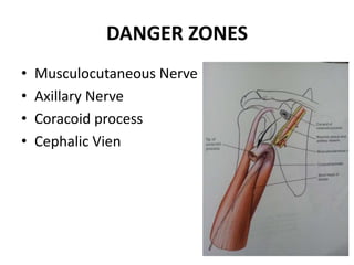 DANGER ZONES
• Musculocutaneous Nerve
• Axillary Nerve
• Coracoid process
• Cephalic Vien
 