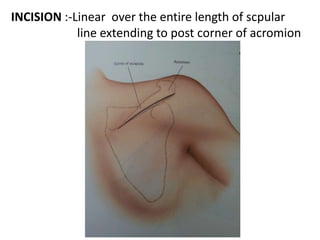 INCISION :-Linear over the entire length of scpular
line extending to post corner of acromion
 