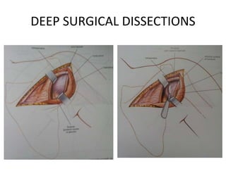 DEEP SURGICAL DISSECTIONS
 
