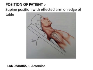 POSITION OF PATIENT :-
Supine position with effected arm on edge of
table
LANDMARKS :- Acromion
 