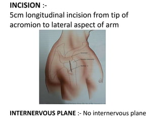 INCISION :-
5cm longitudinal incision from tip of
acromion to lateral aspect of arm
INTERNERVOUS PLANE :- No internervous plane
 