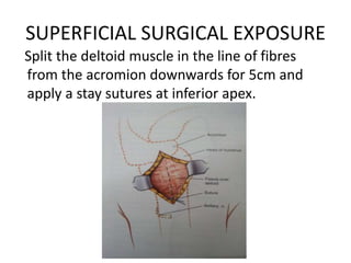 SUPERFICIAL SURGICAL EXPOSURE
Split the deltoid muscle in the line of fibres
from the acromion downwards for 5cm and
apply a stay sutures at inferior apex.
 