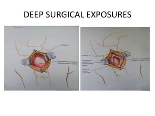 DEEP SURGICAL EXPOSURES
 