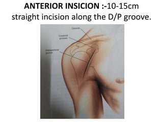 ANTERIOR INSICION :-10-15cm
straight incision along the D/P groove.
 