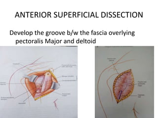 ANTERIOR SUPERFICIAL DISSECTION
Develop the groove b/w the fascia overlying
pectoralis Major and deltoid
 