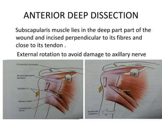 ANTERIOR DEEP DISSECTION
Subscapularis muscle lies in the deep part part of the
wound and incised perpendicular to its fibres and
close to its tendon .
External rotation to avoid damage to axillary nerve
 