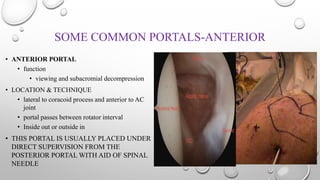 SOME COMMON PORTALS-ANTERIOR
• ANTERIOR PORTAL
• function
• viewing and subacromial decompression
• LOCATION & TECHNIQUE
• lateral to coracoid process and anterior to AC
joint
• portal passes between rotator interval
• Inside out or outside in
• THIS PORTAL IS USUALLY PLACED UNDER
DIRECT SUPERVISION FROM THE
POSTERIOR PORTAL WITH AID OF SPINAL
NEEDLE
 