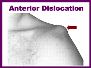 Anterior Dislocation
 