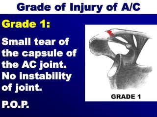 Grade of Injury of A/C
Grade 1:
Small tear of
the capsule of
the AC joint.
No instability
of joint.
P.O.P.
 