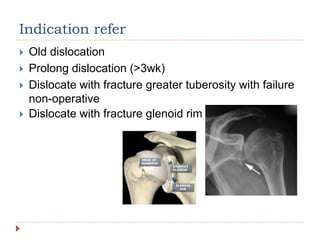 Indication refer
 Old dislocation
 Prolong dislocation (>3wk)
 Dislocate with fracture greater tuberosity with failure
non-operative
 Dislocate with fracture glenoid rim
 