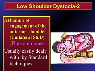 A)A) Failure ofFailure of
engagement of theengagement of the
anterior shoulderanterior shoulder
(Unilateral Sh.D).(Unilateral Sh.D).
,The commonest:
Usually easily dealt
with by Standard
techniques
2-Low Shoulder Dystocia
 