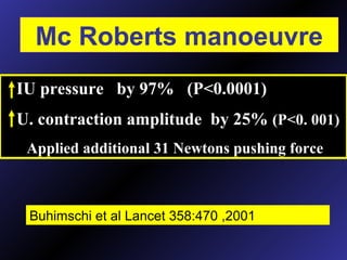 IU pressure by 97% (P<0.0001)
U. contraction amplitude by 25% (P<0. 001)
Applied additional 31 Newtons pushing force
Buhimschi et al Lancet 358:470 ,2001
Mc Roberts manoeuvre
 