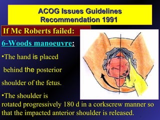 ACOG Issues GuidelinesACOG Issues Guidelines
Recommendation 1991Recommendation 1991
.
If Mc Roberts failed:If Mc Roberts failed:
6-Woods manoeuvre6-Woods manoeuvre::
•The hand is placed
behind the posterior
shoulder of the fetus.
•The shoulder is
rotated progressively 180 d in a corkscrew manner so
that the impacted anterior shoulder is released.
 