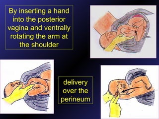 By inserting a hand
into the posterior
vagina and ventrally
rotating the arm at
the shoulder
delivery
over the
perineum
 