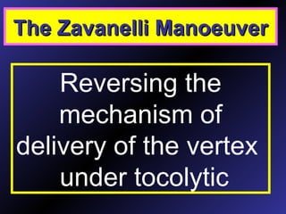 The Zavanelli ManoeuverThe Zavanelli Manoeuver
Reversing the
mechanism of
delivery of the vertex
under tocolytic
 