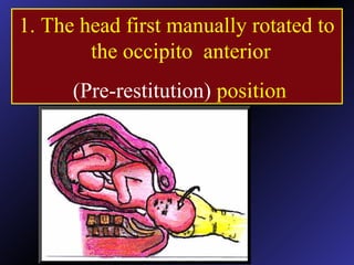 1. The head first manually rotated to
the occipito anterior
(Pre-restitution) position
 