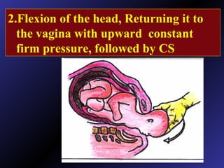 2.Flexion of the head, Returning it to
the vagina with upward constant
firm pressure, followed by CS
 