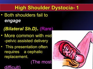 • Both shoulders fail to
engage
(Bilateral Sh.D). (Rare)
• More common with mid
-pelvic assisted delivery
• This presentation often
requires a cephalic
replacement.
(The most
difficult)
11--HighHigh Shoulder DystociaShoulder Dystocia
 