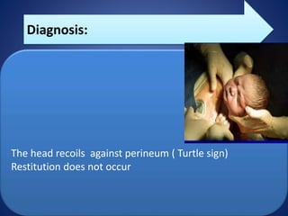 shoulder-dystocia.pptx