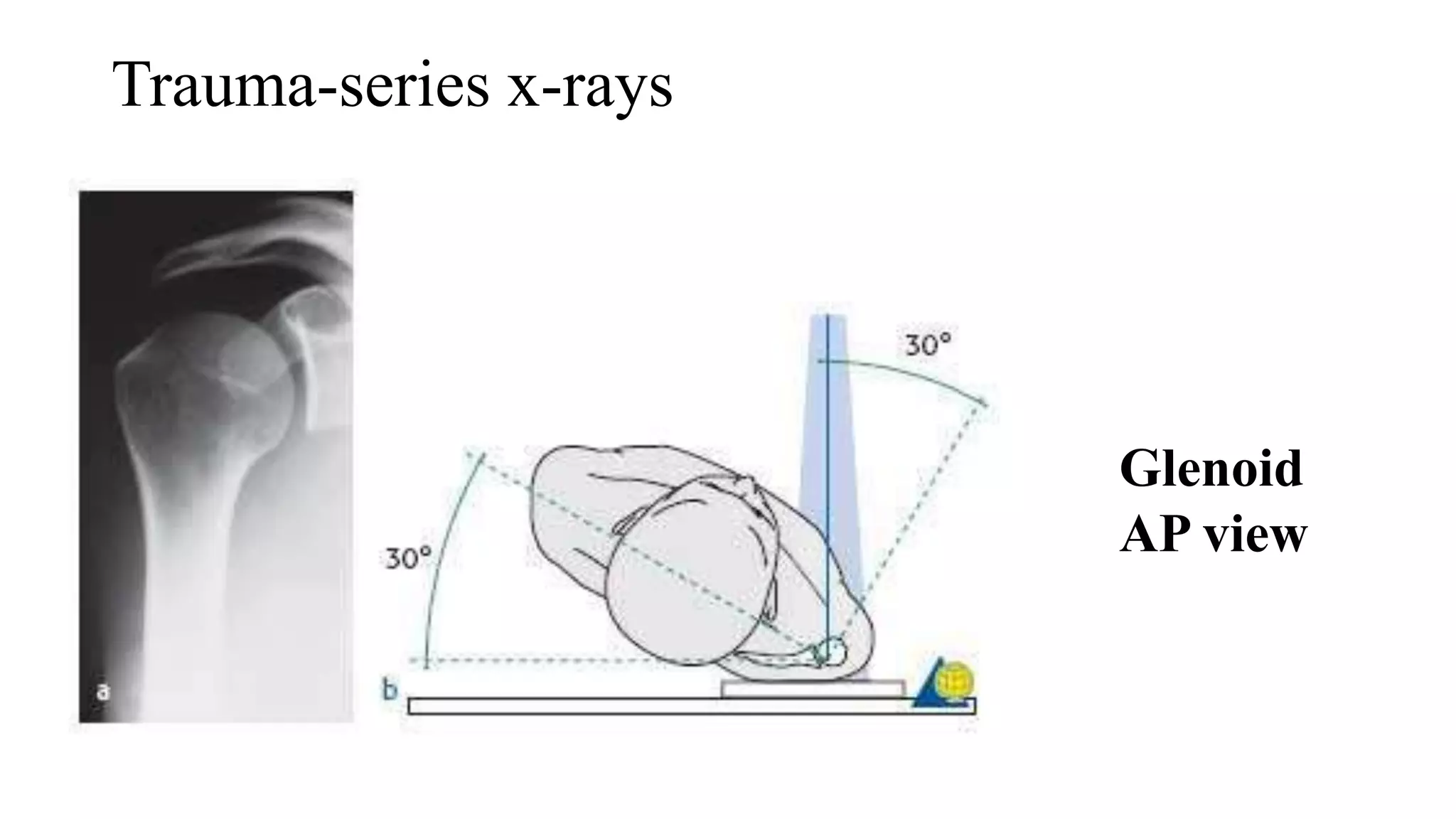 Trauma-series x-rays
Glenoid
AP view
 