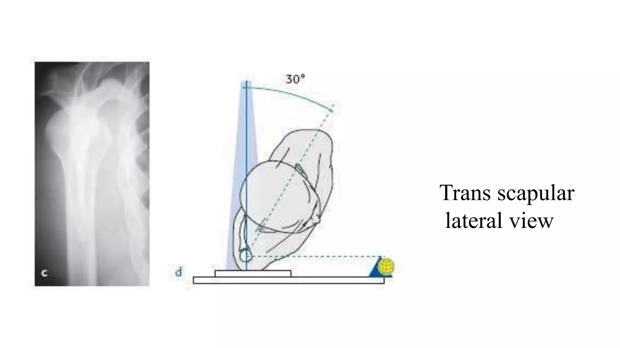 Trans scapular
lateral view
 