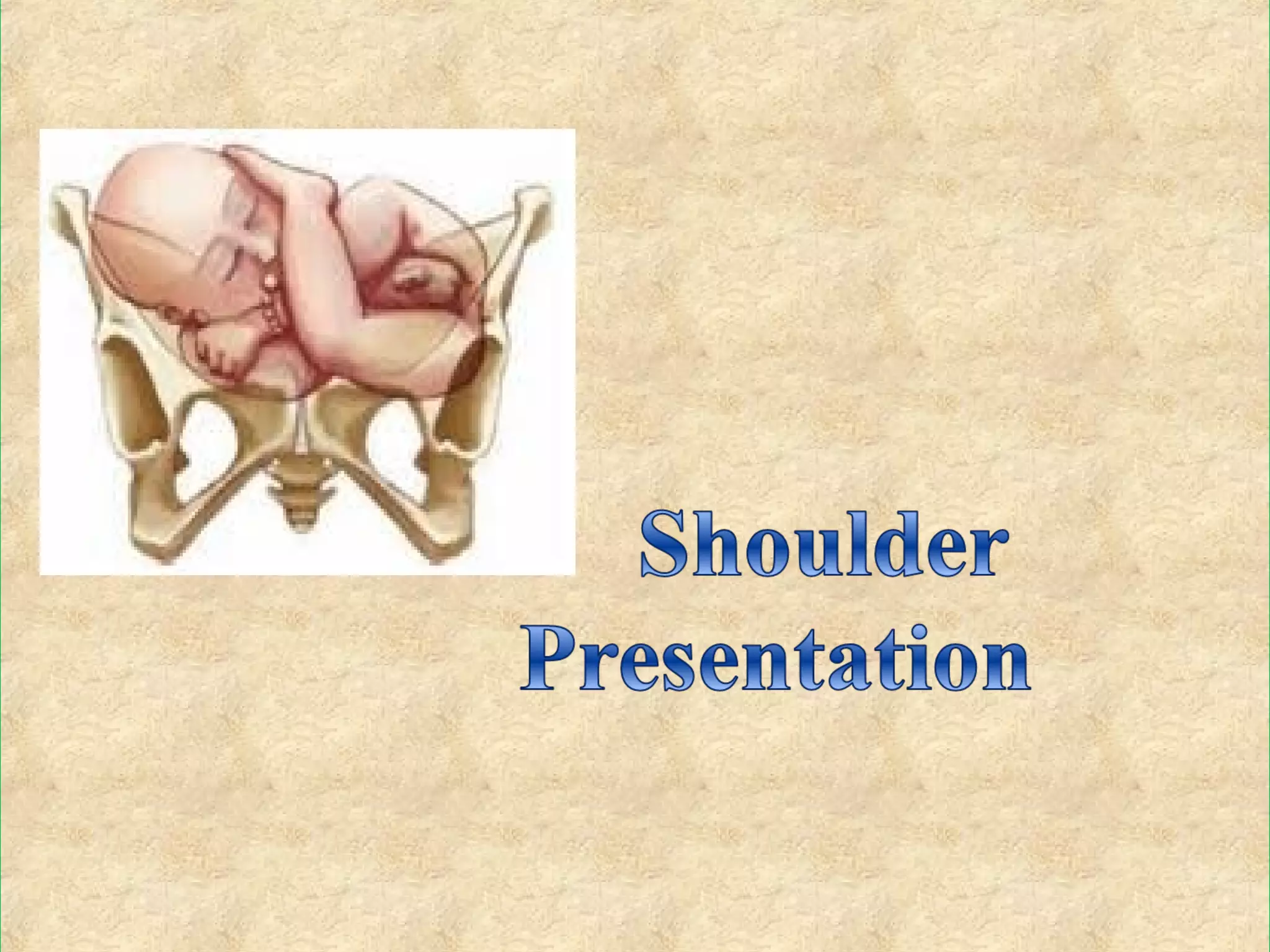 Shoulder presentation | PPT