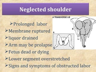 a neglected shoulder presentation will be diagnosed when