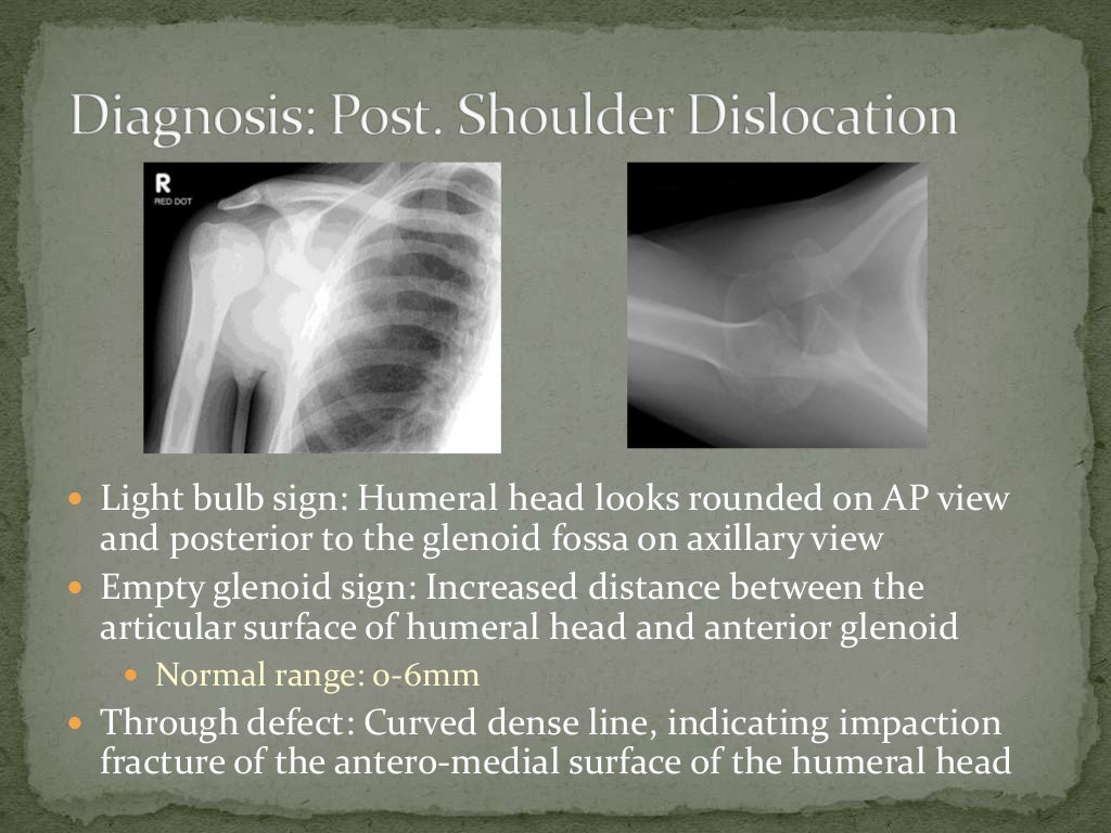 Posterior Shoulder Dislocation