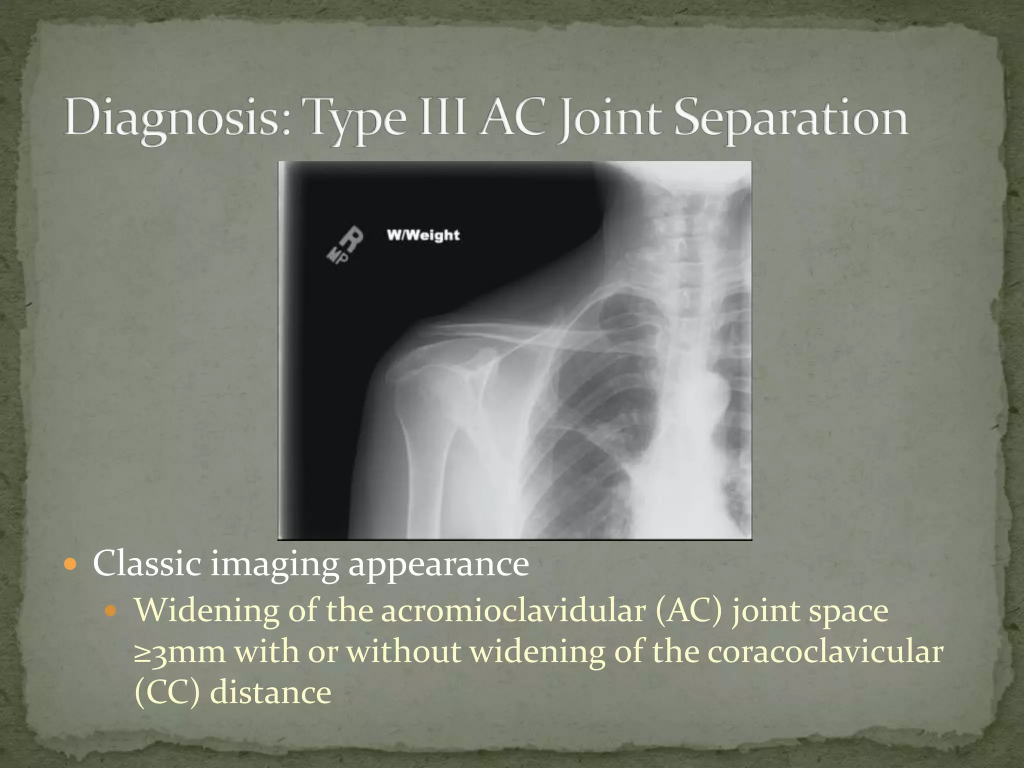 ď Classic imaging appearance
ď Widening of the acromioclavidular (AC) joint space
âĽ3mm with or without widening of the coracoclavicular
(CC) distance