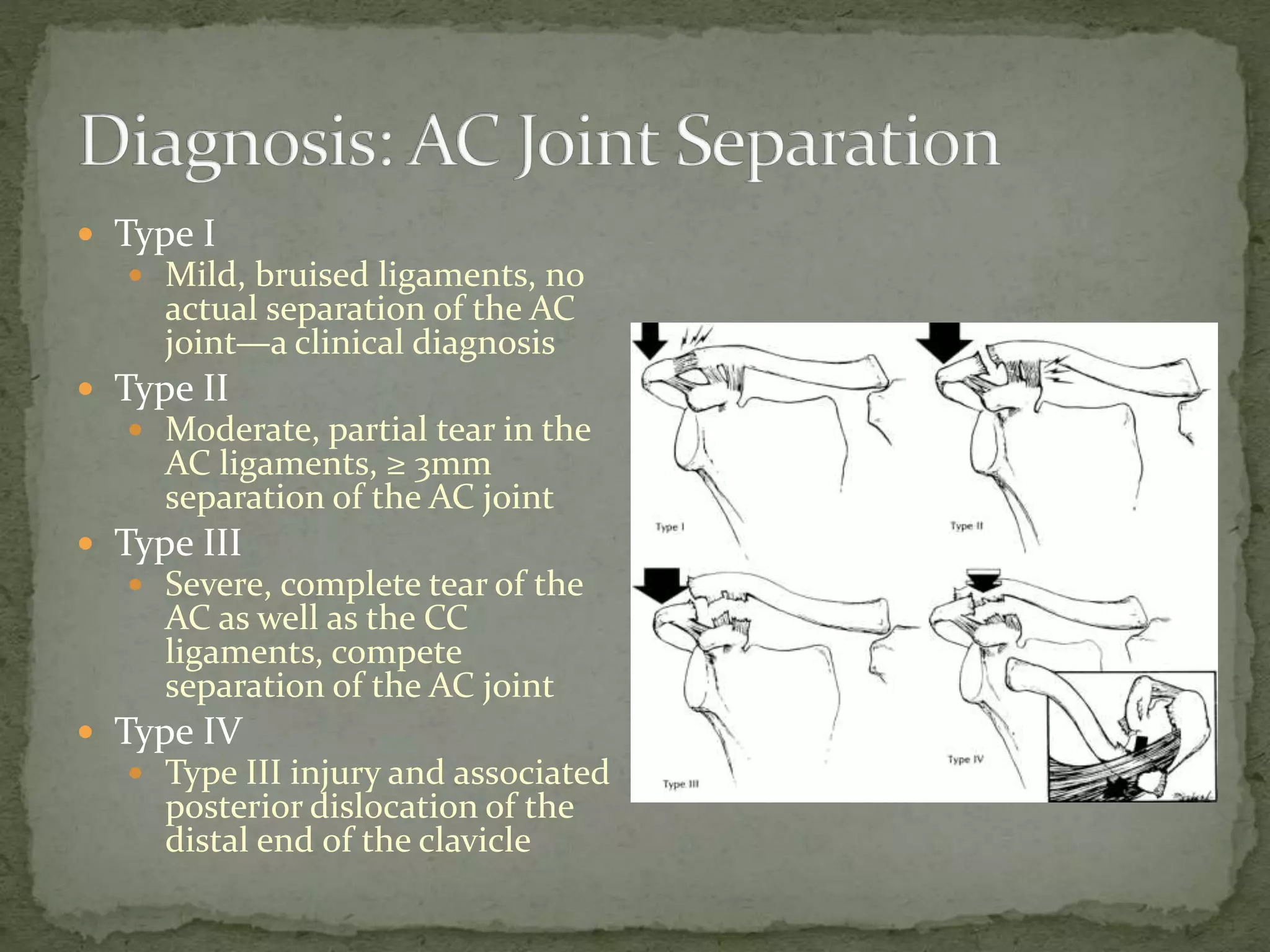 ď Type I
ď Mild, bruised ligaments, no
actual separation of the AC
jointâa clinical diagnosis
ď Type II
ď Moderate, partial tear in the
AC ligaments, ⼠3mm
separation of the AC joint
ď Type III
ď Severe, complete tear of the
AC as well as the CC
ligaments, compete
separation of the AC joint
ď Type IV
ď Type III injury and associated
posterior dislocation of the
distal end of the clavicle