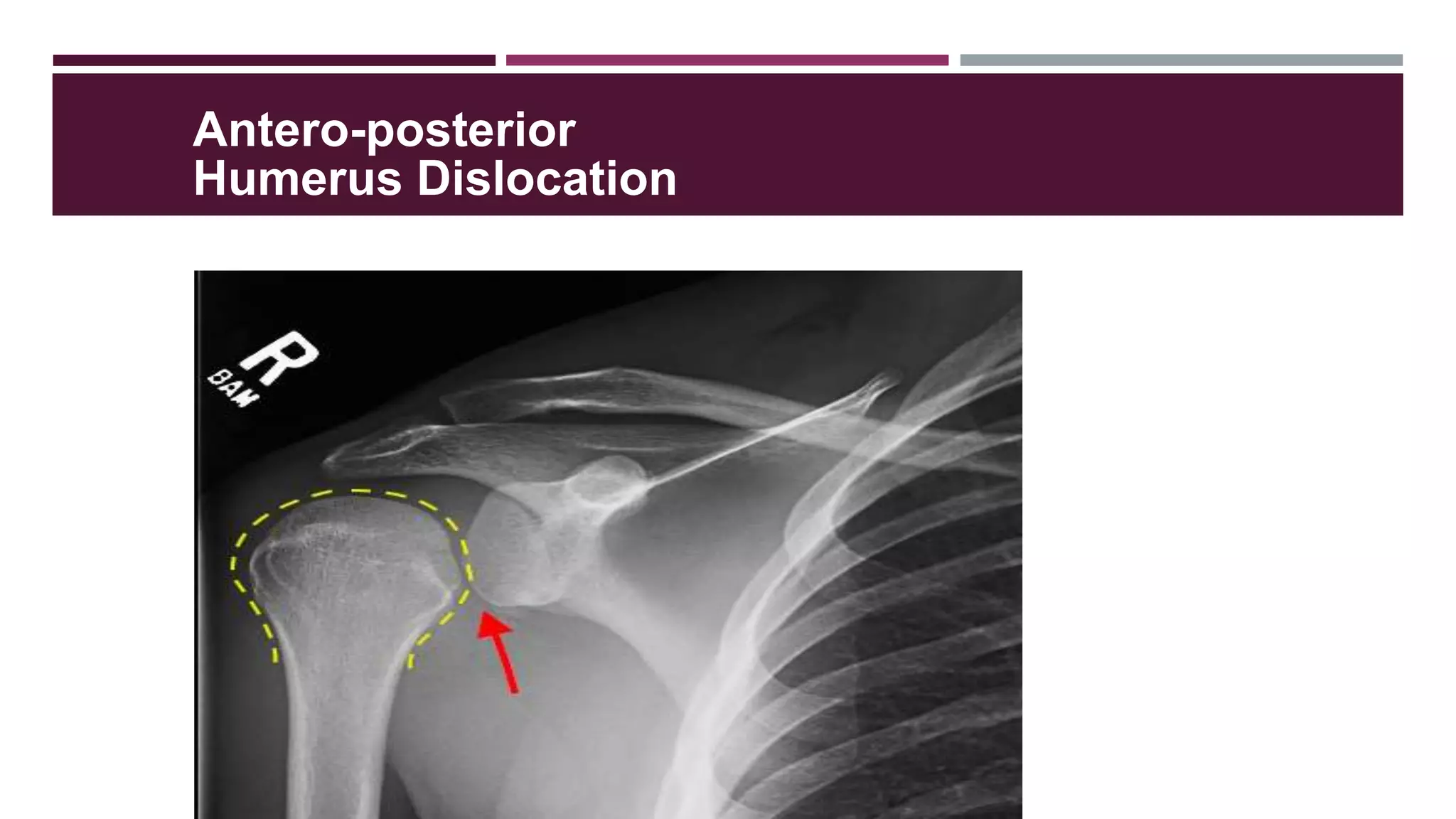 Humurus Dislocation SHOULDER POSITIONING - ANAND GURMAITA ( BSc. RADIOLOGY ) | PPTX