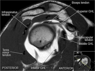 Shoulder Geode MRI of Shoulder anatomy | PPTX