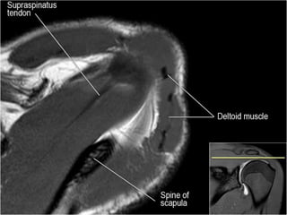 MRI of Shoulder anatomy