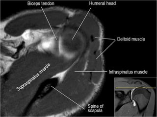 MRI of Shoulder anatomy