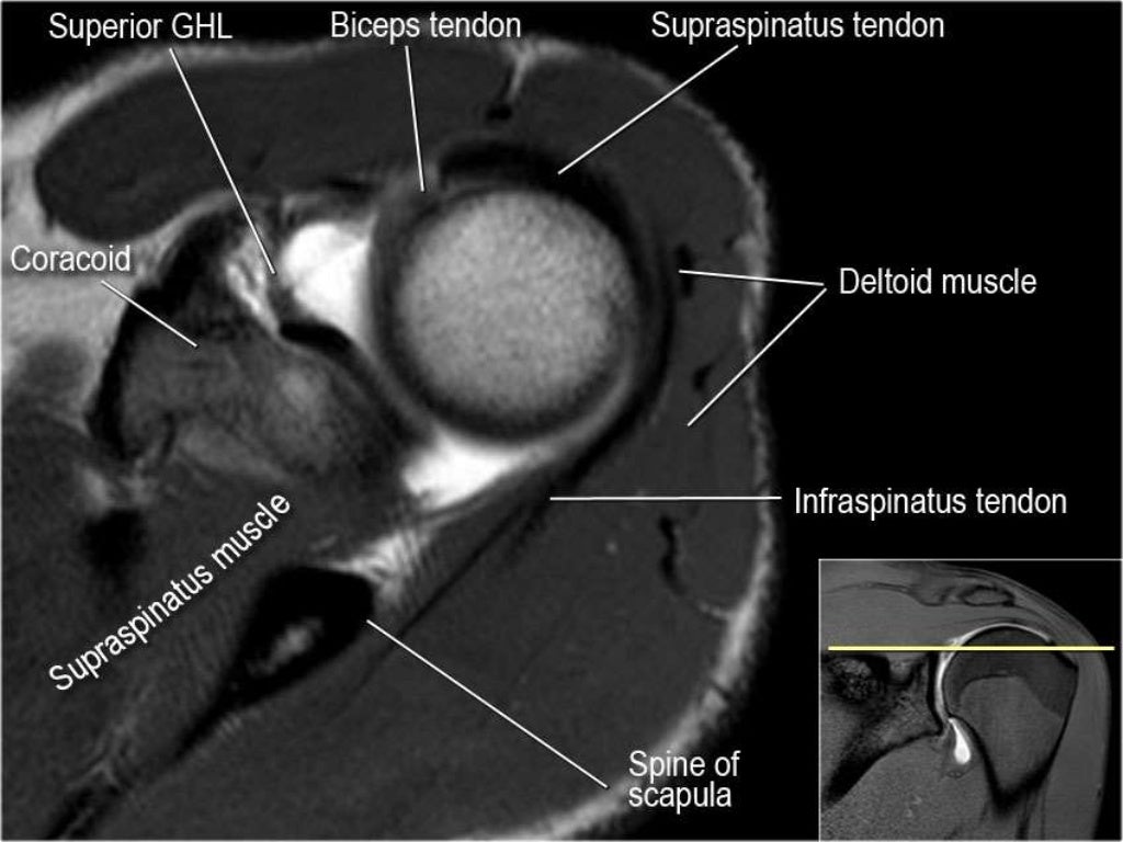 MRI of Shoulder anatomy
